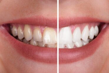 Estética dental
