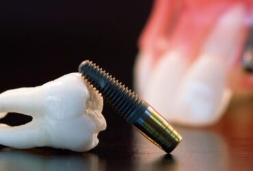 Implantes Dentales