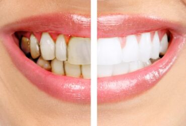 Periodoncia
