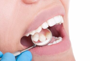 Caries Dental