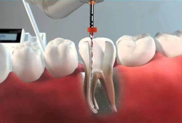 Endodoncia